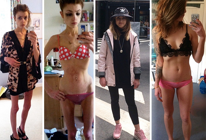 Потрясающее восстановление девушек, которые доказали, что анорексию можно победить