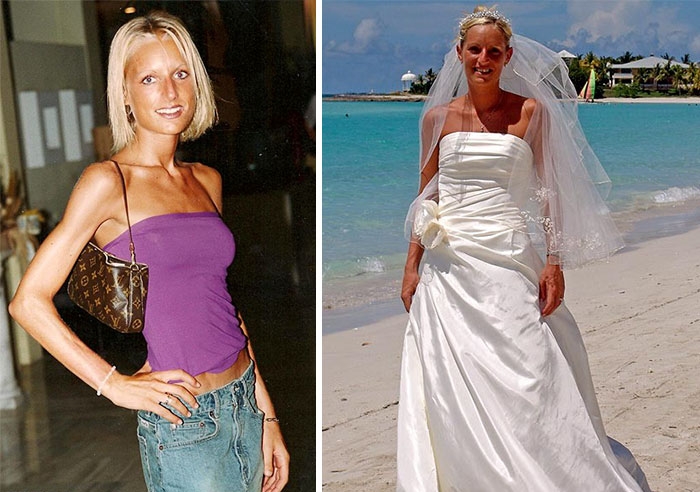 Потрясающее восстановление девушек, которые доказали, что анорексию можно победить