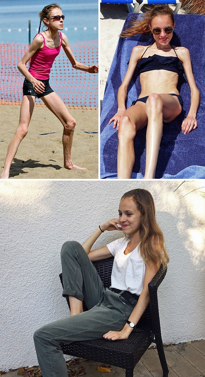 Потрясающее восстановление девушек, которые доказали, что анорексию можно победить