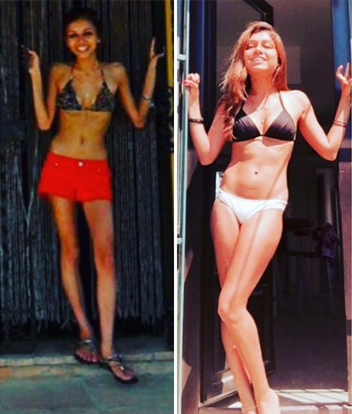 Потрясающее восстановление девушек, которые доказали, что анорексию можно победить