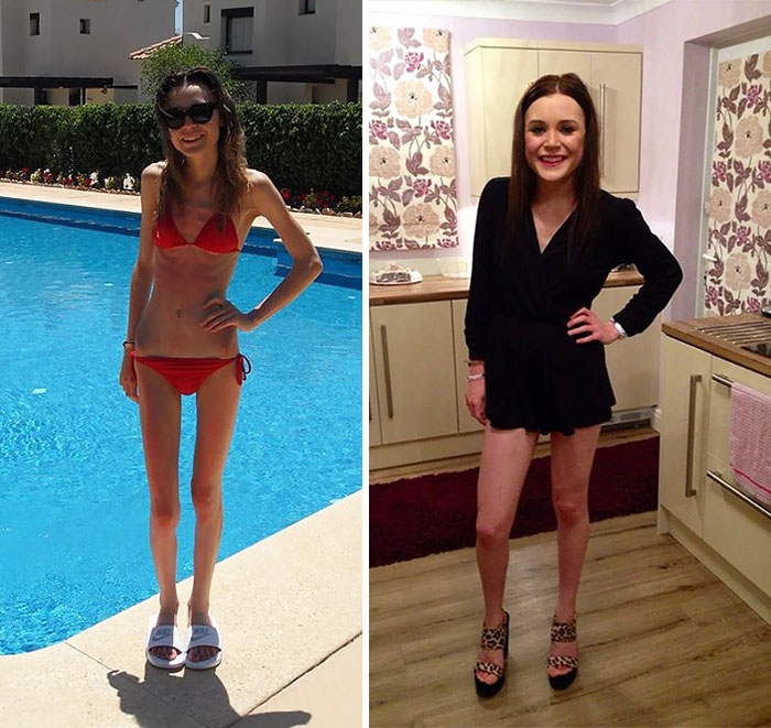 Потрясающее восстановление девушек, которые доказали, что анорексию можно победить