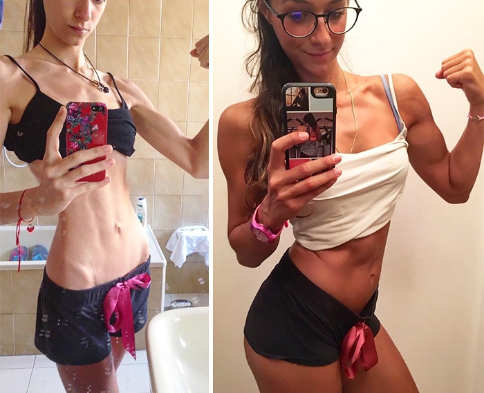 Потрясающее восстановление девушек, которые доказали, что анорексию можно победить