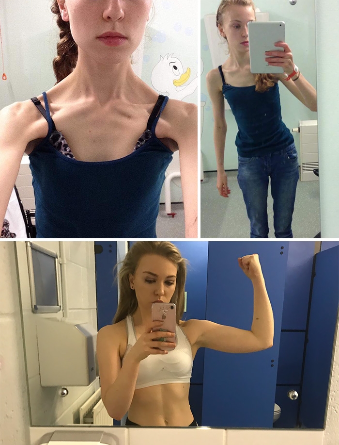 Потрясающее восстановление девушек, которые доказали, что анорексию можно победить