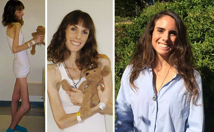 Потрясающее восстановление девушек, которые доказали, что анорексию можно победить